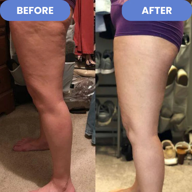 SculptEase - Cellulite Treatment 4-in-1